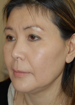 Before Image: Face Lift - left-front-oblique