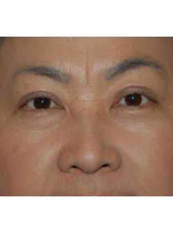 After Image: Asian Double Eyelid - front