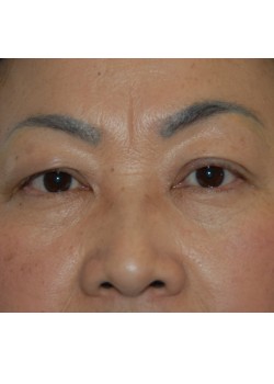 Before Image: Asian Double Eyelid - front