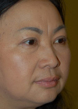 After Image: Asian Double Eyelid - right-front-oblique