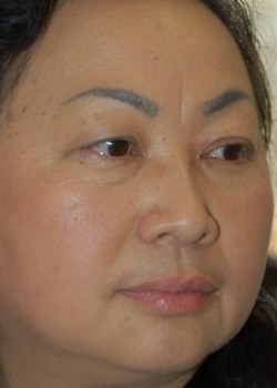 Before Image: Asian Double Eyelid - right-front-oblique