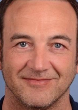 After Image: Upper and Lower Eyelid - front