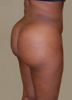 After Image: Brazilian Butt Lift - right-front-oblique