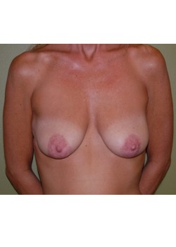 Before Image: Breast Lift with Implants - front