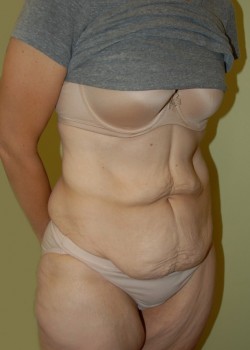 Before Image: Tummy Tuck - right-front-oblique