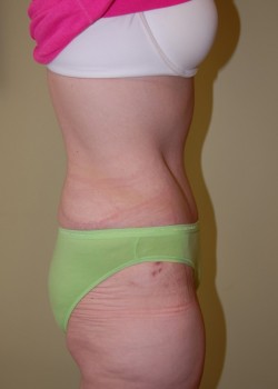 After Image: Tummy Tuck - other