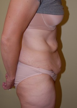 Before Image: Tummy Tuck - other