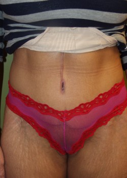 After Image: Tummy Tuck w/ Liposuction - front