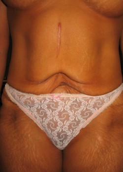 Before Image: Tummy Tuck w/ Liposuction - front