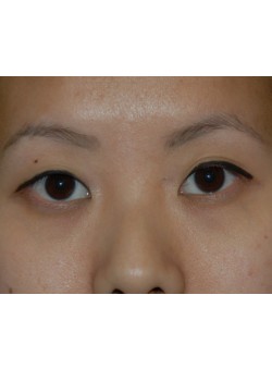 Before Image: Asian Double Eyelid - front