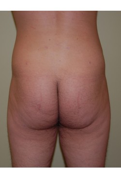 After Image: Brazilian Butt Lift - front