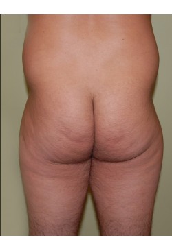 Before Image: Brazilian Butt Lift - front