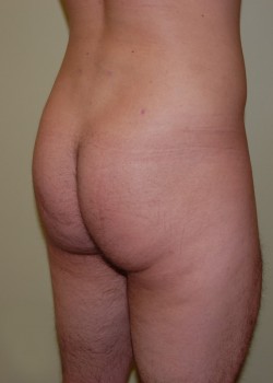 After Image: Brazilian Butt Lift - right-front-oblique