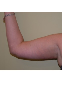 After Image: Arm Lift - front