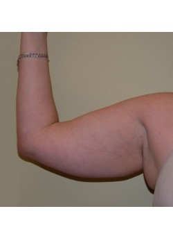 Before Image: Arm Lift - front