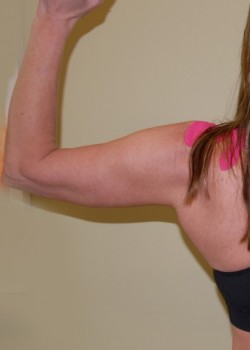 After Image: Arm Lift - front