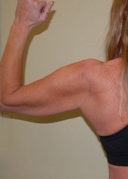 Before Image: Arm Lift - front