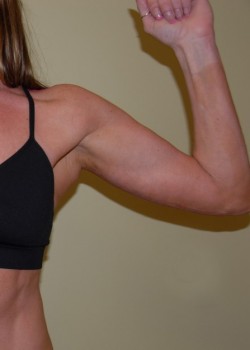 After Image: Arm Lift - front