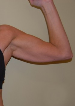 Before Image: Arm Lift - front