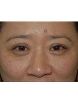 After Image: Asian Double Eyelid - front