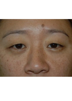 Before Image: Asian Double Eyelid - front