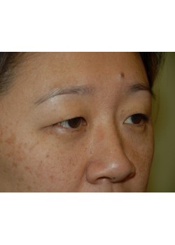 Before Image: Asian Double Eyelid - right-front-oblique