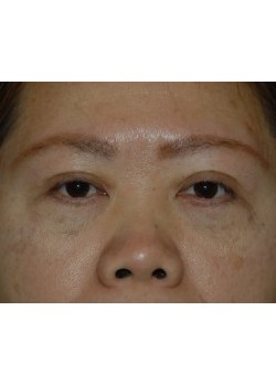 After Image: Asian Double Eyelid - front