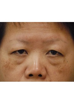 Before Image: Asian Double Eyelid - front
