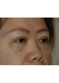 After Image: Asian Double Eyelid - right-front-oblique