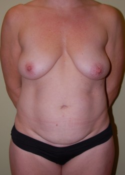 Before Image: Tummy Tuck, Liposuction, Breast Lift with Implants - front
