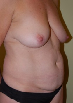 Before Image: Tummy Tuck, Liposuction, Breast Lift with Implants - right-front-oblique
