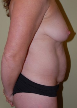 Before Image: Tummy Tuck, Liposuction, Breast Lift with Implants - other