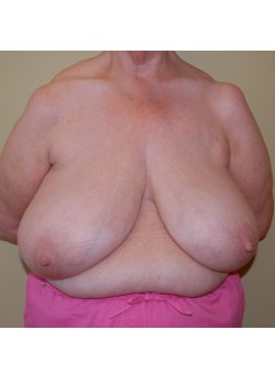 Before Image: Breast Reduction - front