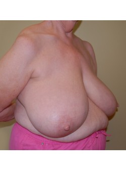 Before Image: Breast Reduction - right-front-oblique