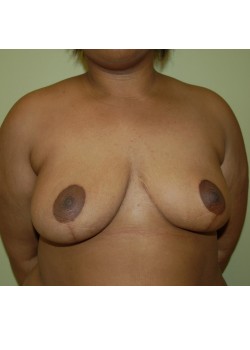 After Image: Breast Reduction - front