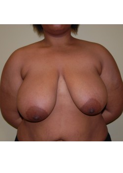 Before Image: Breast Reduction - front