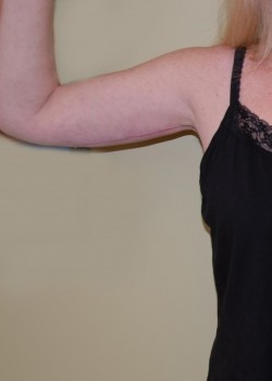 After Image: Arm Lift - front