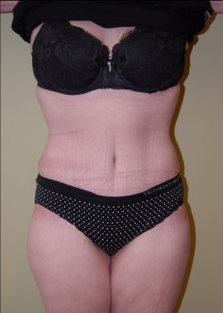After Image: Tummy Tuck with Liposuction - front