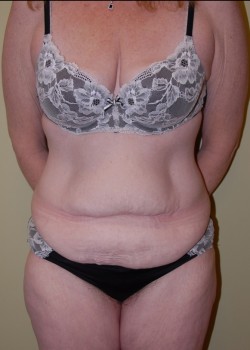 Before Image: Tummy Tuck with Liposuction - front