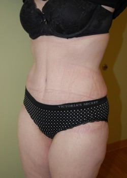 After Image: Tummy Tuck with Liposuction - left-front-oblique