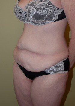 Before Image: Tummy Tuck with Liposuction - left-front-oblique
