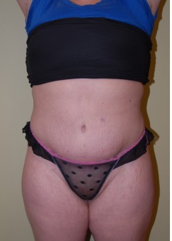 After Image: Tummy Tuck with Liposuction - front
