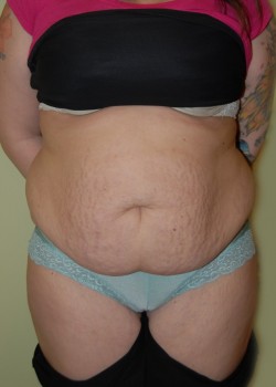 Before Image: Tummy Tuck with Liposuction - front