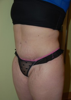 After Image: Tummy Tuck with Liposuction - left-front-oblique