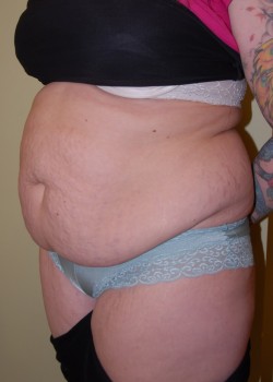 Before Image: Tummy Tuck with Liposuction - left-front-oblique