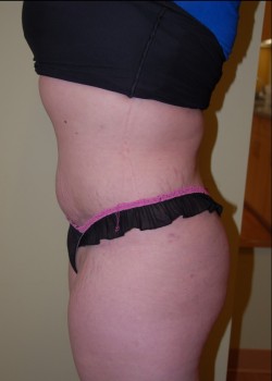 After Image: Tummy Tuck with Liposuction - other