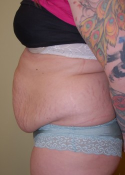 Before Image: Tummy Tuck with Liposuction - other