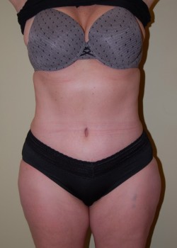 After Image: Tummy Tuck with Liposuction - front