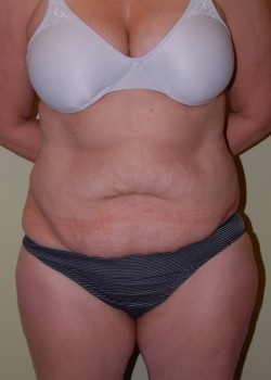Before Image: Tummy Tuck with Liposuction - front