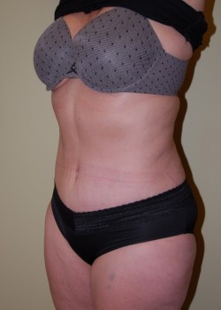 After Image: Tummy Tuck with Liposuction - left-front-oblique